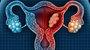 Cáncer de Endometrio