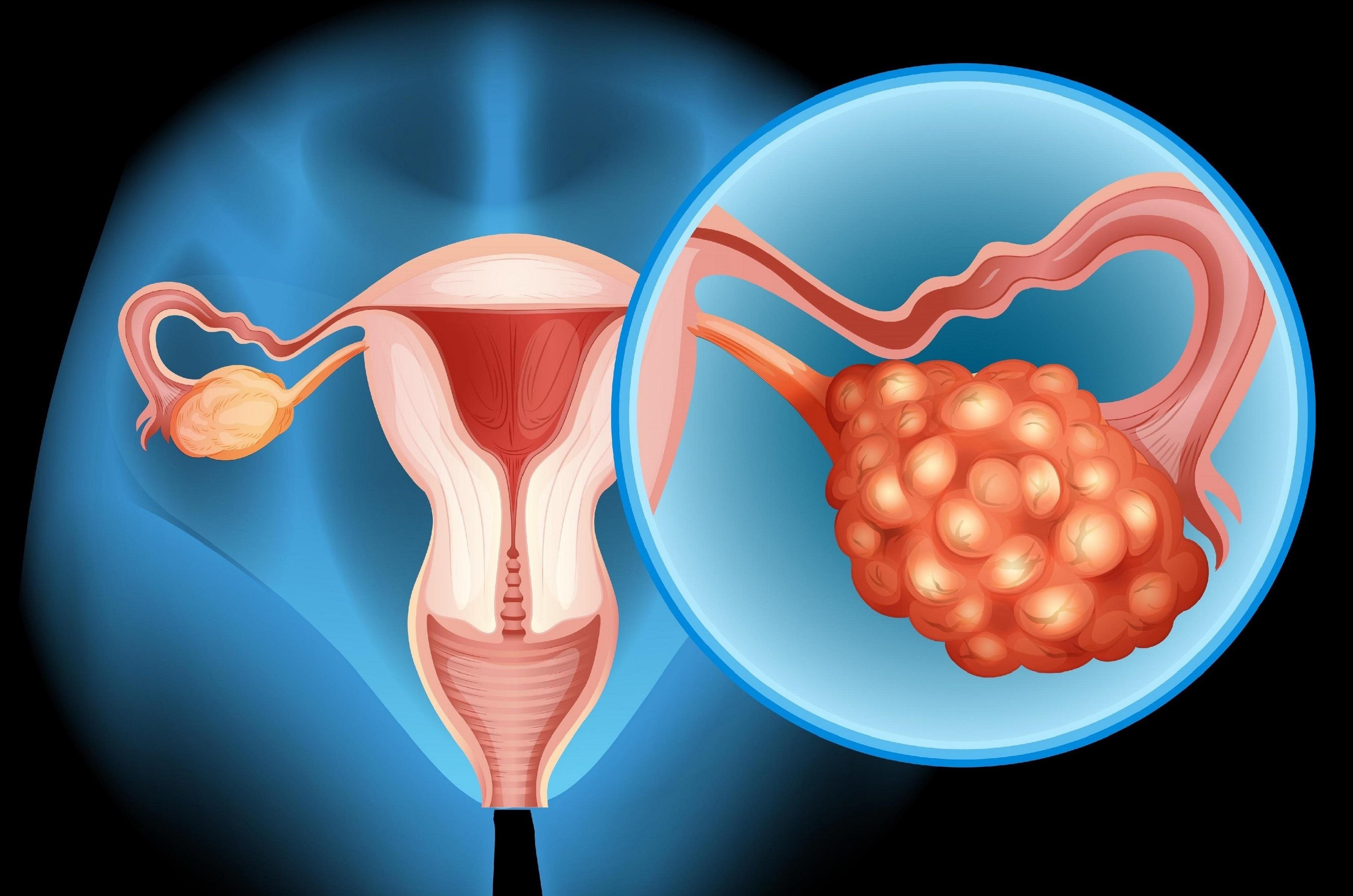 Cáncer de Ovario
